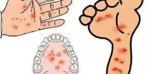 手足口病来袭，如何预防不“中招”