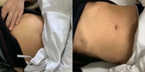 中医药妙用！一男子肚脐长出“乒乓球”，六副中药下去腹部“瘦”了48cm