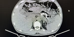 吓人！男子突感腹痛、腹胀，竟查出西瓜大小的……