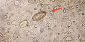 泸州有人吃生鱼片感染肝吸虫？医生提醒：这种食物少吃！