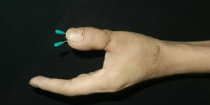 牛！男子4根手指被斩断，泸州这家医院用脚趾再造“新拇指”……