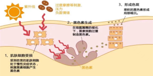脸上长斑了，该怎么办？