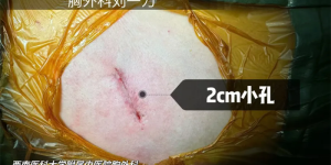 【围观】泸州嬢嬢查出肺癌，不敢手术，结果……