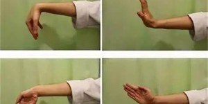 认识桡骨远端骨折 守护骨骼健康