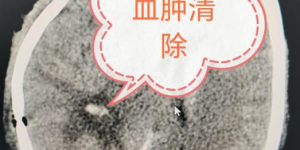 罕见！泸州17岁花季少女中风，20余天后……