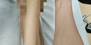 体重仅有60斤左右，瘦骨嶙峋的老人骨折了······