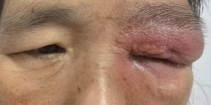 【病例分享】误用草药治疗睑黄瘤险毁容？科学识别与处理指南助您避坑！