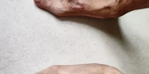 3D打印技术助力跖骨修复，王先生开启自由行走的全新人生！