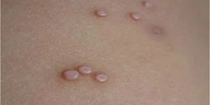 去了趟水上乐园，脸上、大腿长满“小肉粒”！ 大人、两娃都中招……