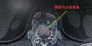泸州女士爬树摘桂圆，遭得惨……